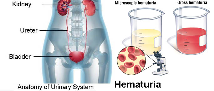 Blood in Urine - Hematuria Causes, Symptoms, Diagnosis, Complications, Treatment in India
