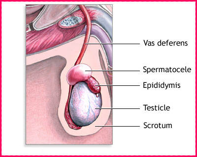 Spermatoceles Causes, Symptoms, Diagnosis, Complications, Treatment in India