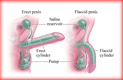 what is penile prosthesis and how it works