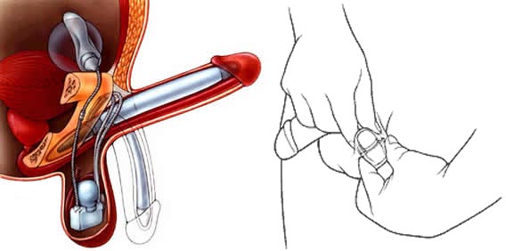 Three-piece inflatable penile implants