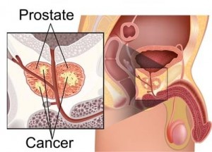 erectile-dysfunction-causes-prostate-cancer