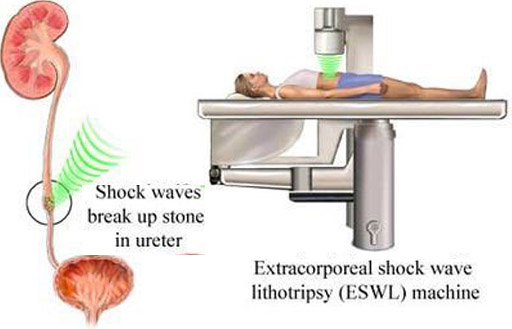 extracorporeal shock wave lithotripsy treatment cost in india