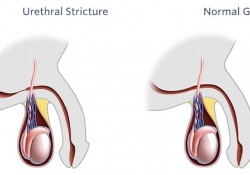 Urethral Stricture Disease and Treatment in India