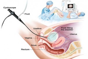 Benign Urethral Lesions, Causes, Symptoms, Types and Treatment in India