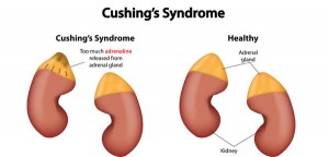 Cushing Syndrome: Signs, Causes, diagnosis Treatment in India