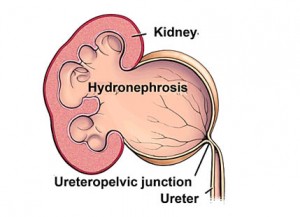 Extrinsic Obstruction of the Ureter Causes, Symptoms, Diagnosis, Complications, Treatment in India