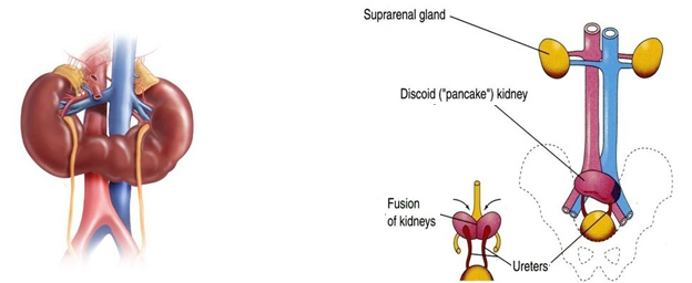 Renal Fusion (Horseshoe Kidney) Causes, Symptoms, Diagnosis, Complications, Treatment in India