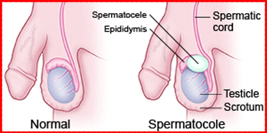 spermatoceles diagnosed and treatment in india