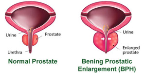 Problem with Your Prostate? Diagnosis, Signs, Symptoms and Treatment in India