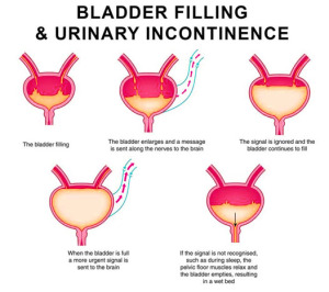 Bladder Filling and Urine incontinence