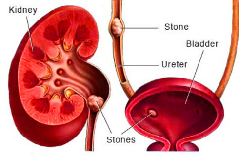 Urinary Problems Sorted - EDTreatmentIndia Hospital's Urology Centre provides a whole range of comprehensive and efficient services