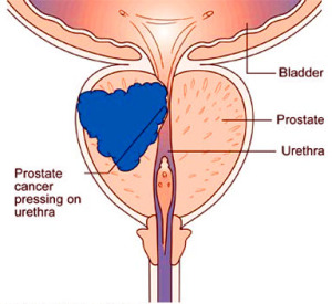 DETECTION OF PROSTATE CANCER