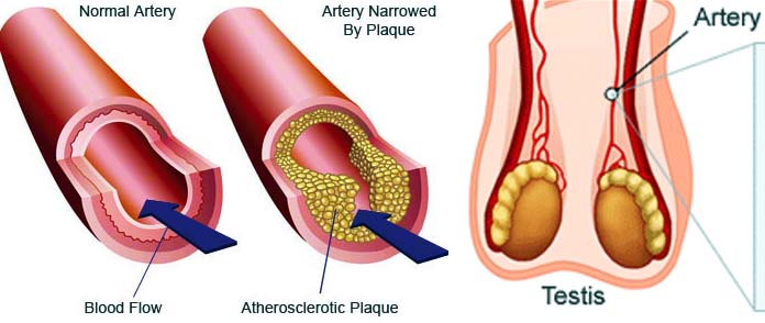 Atherosclerosis and Erectile Dysfunction: Are You at Risk?