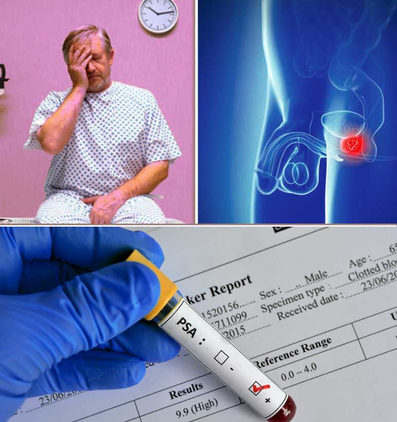 the-problem-with-psa-screenings-prostate-cancer-and-risk