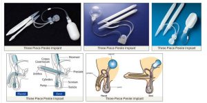 Three Piece Penile Implant Available in India