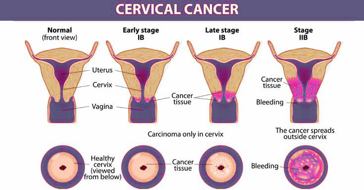 TREATING CERVICAL CANCER