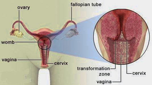 cancer-prone zone where vagina and cervix meet