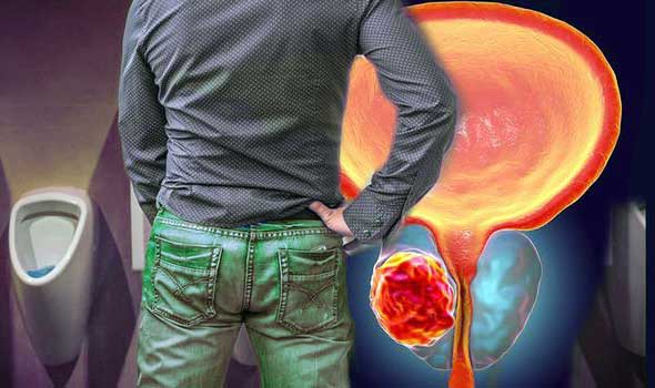Exercise Reduces Prostate Cancer Risk Only For Some Men