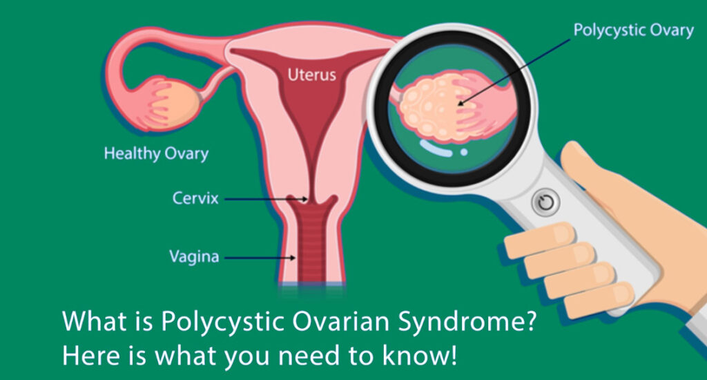 What is Polycystic Ovarian Syndrome? Here is what you need to know
